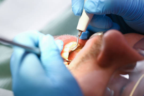 Best Emergency Dental Extractions in New Hackensack, NY