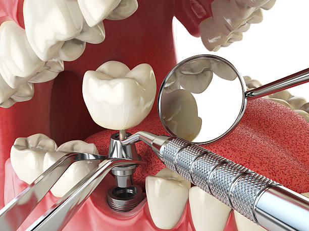 Best Broken or Cracked Tooth Emergency Dentist in New Hackensack, NY